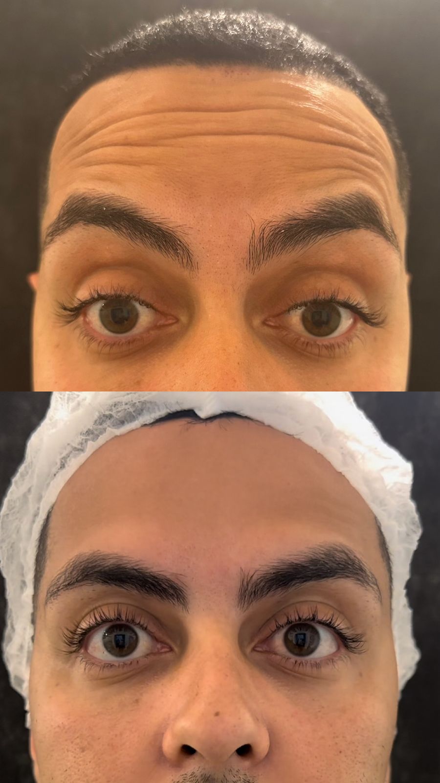 Botox Antes - Rugas de Expressão