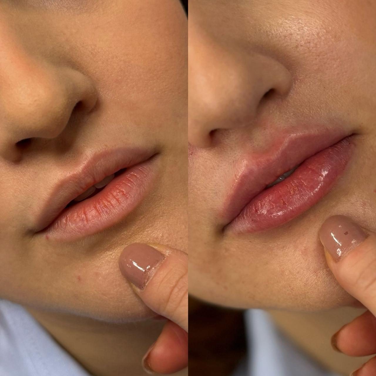 Preenchimento Labial Antes