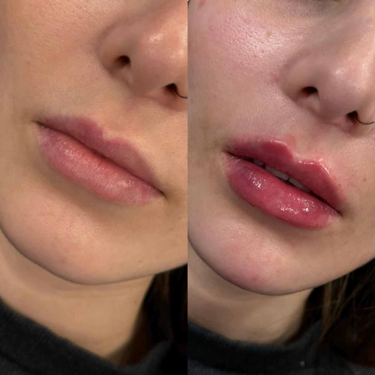 Preenchimento Labial Depois