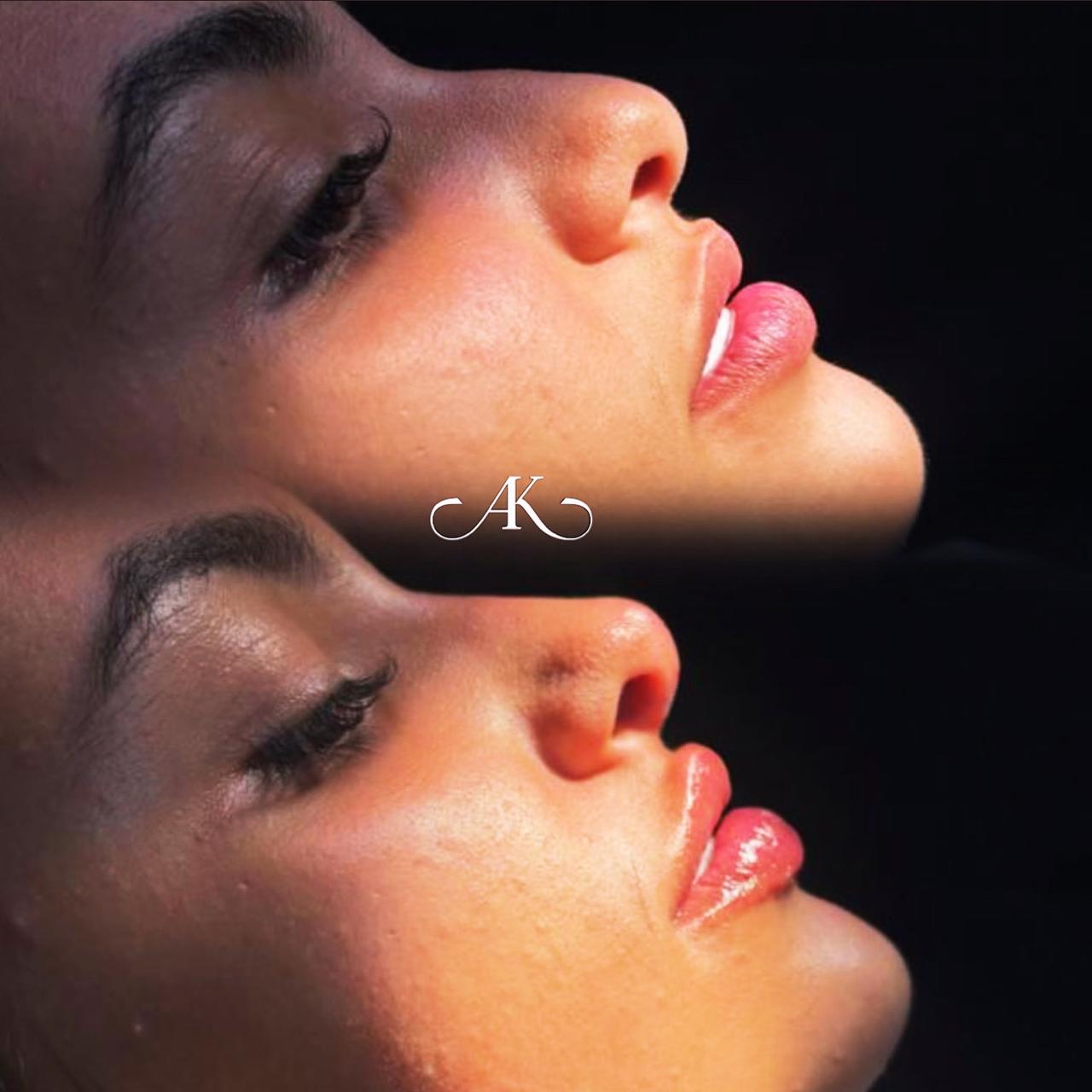 Perfiloplastia - Ângulos Faciais