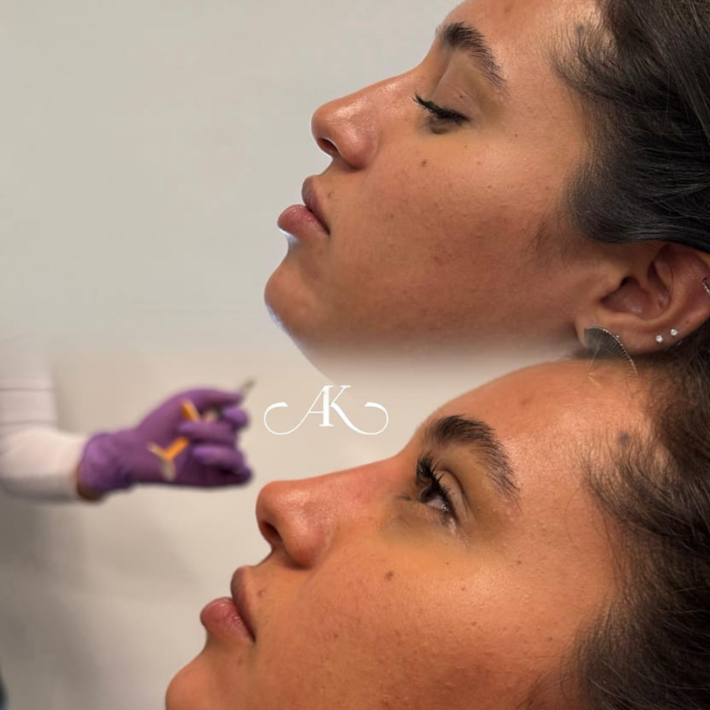 Rinomodelação Antes - Dorso e Ponta